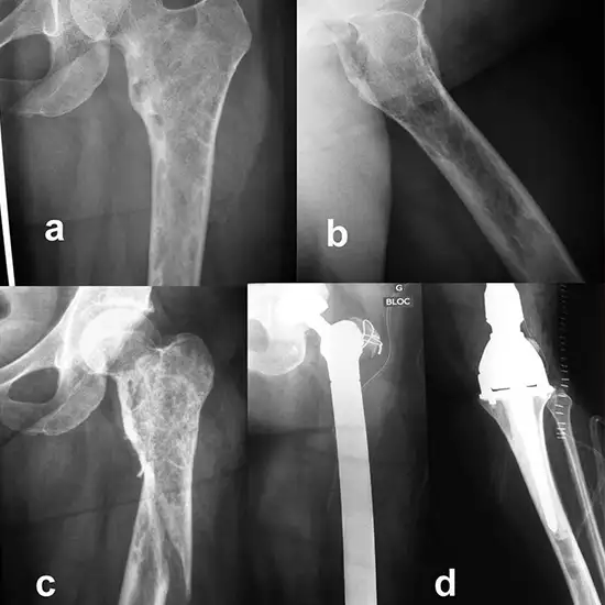 x-ray left thigh-hip ap (anteroposterior) view